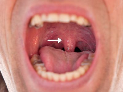 Úvula y cavidad oral — zona de vibración en el ronquido